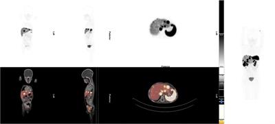 Case report: Peptide receptor radioligand therapy in metastatic pediatric neuroendocrine tumors